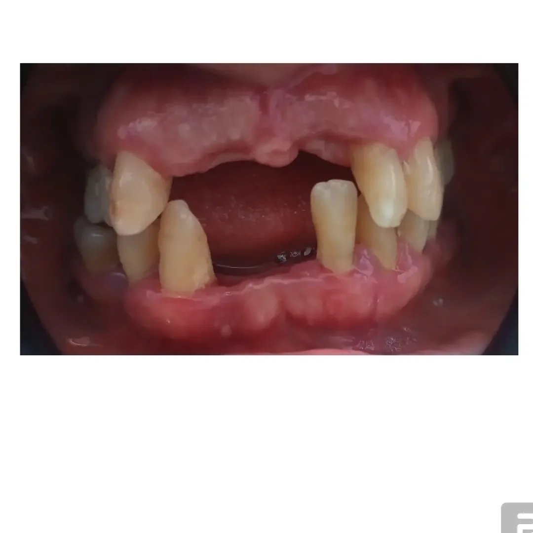 Imagen de Protesis parcial removible